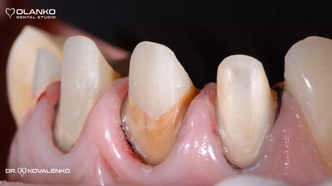 Клинический случай 1 Керамические виниры(коронки)
