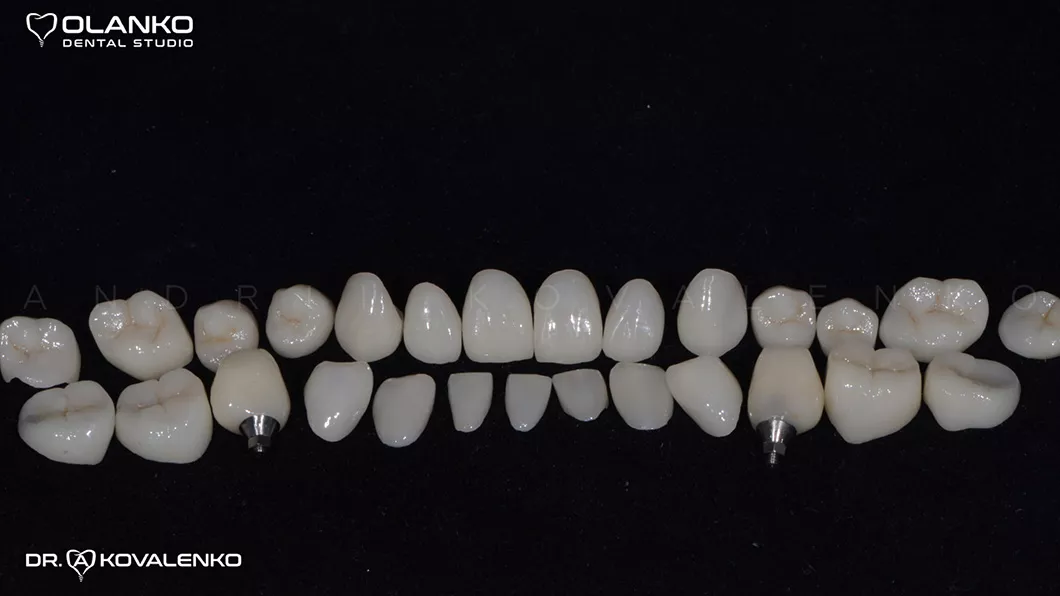 Клинический случай 1 протезирование