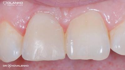Имплантация зубов,примеры работ до и после.Фотогалерея имплантация зубов.