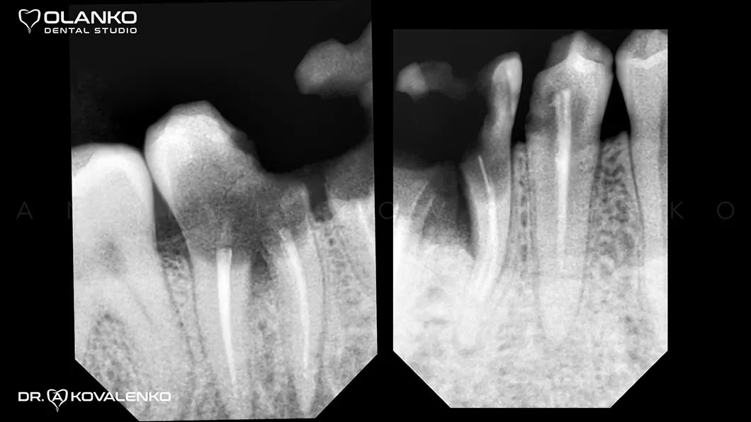 Клинический случай 4 имплантация зубов