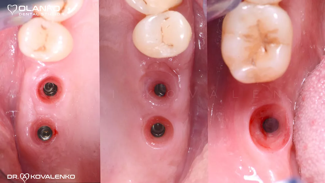 Клинический случай 2 имплантация зубов
