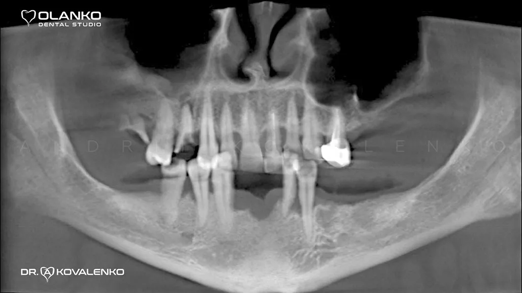 Клинический случай 1 имплантация зубов