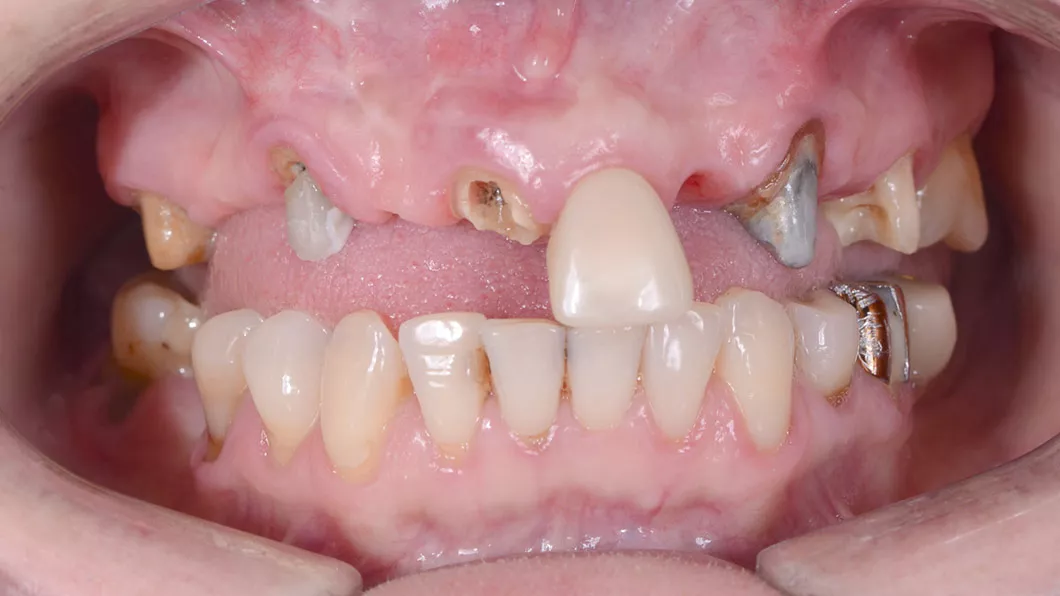 Клинический случай 3 имплантация зубов