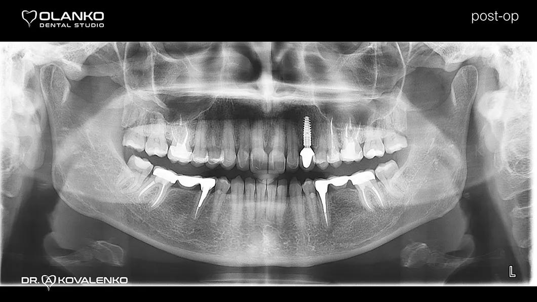 Клинический случай 3 протезирование