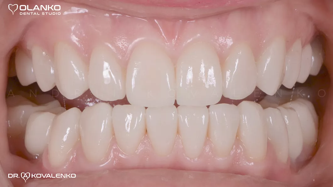 Клинический случай 1 протезирование