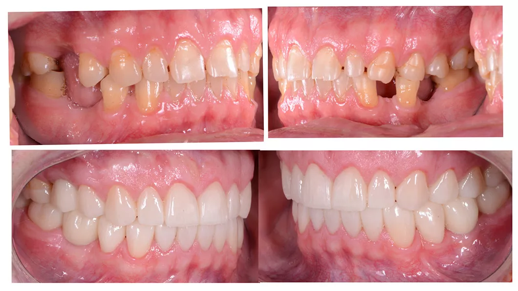 Клинический случай 2 протезирование