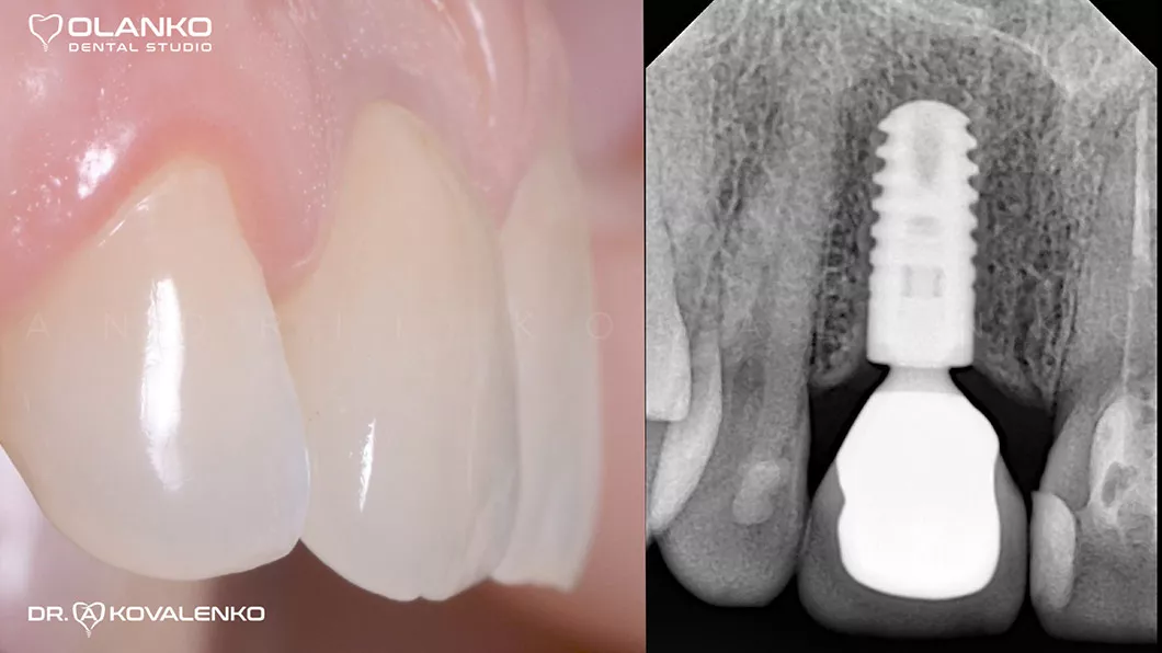 Клинический случай 5 имплантация зубов