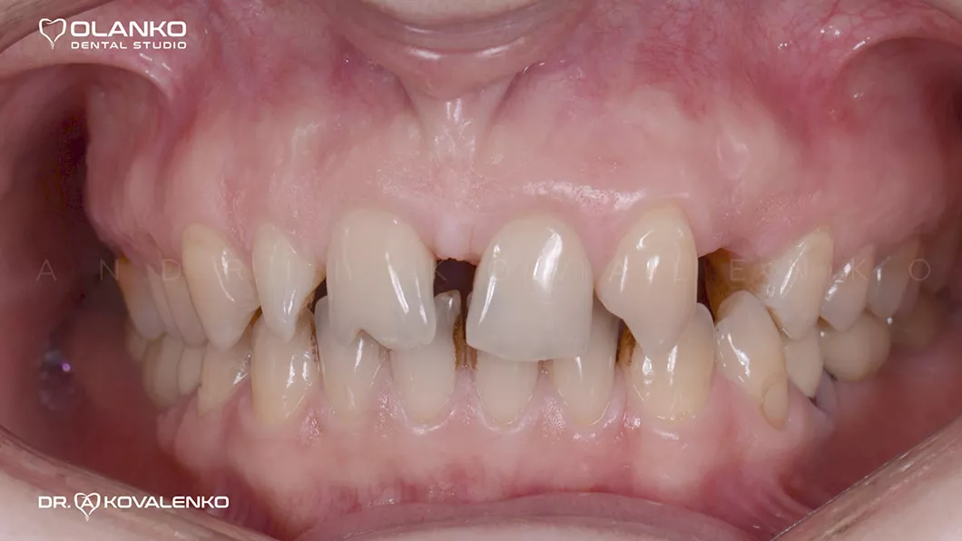 Клинический случай 3 протезирование