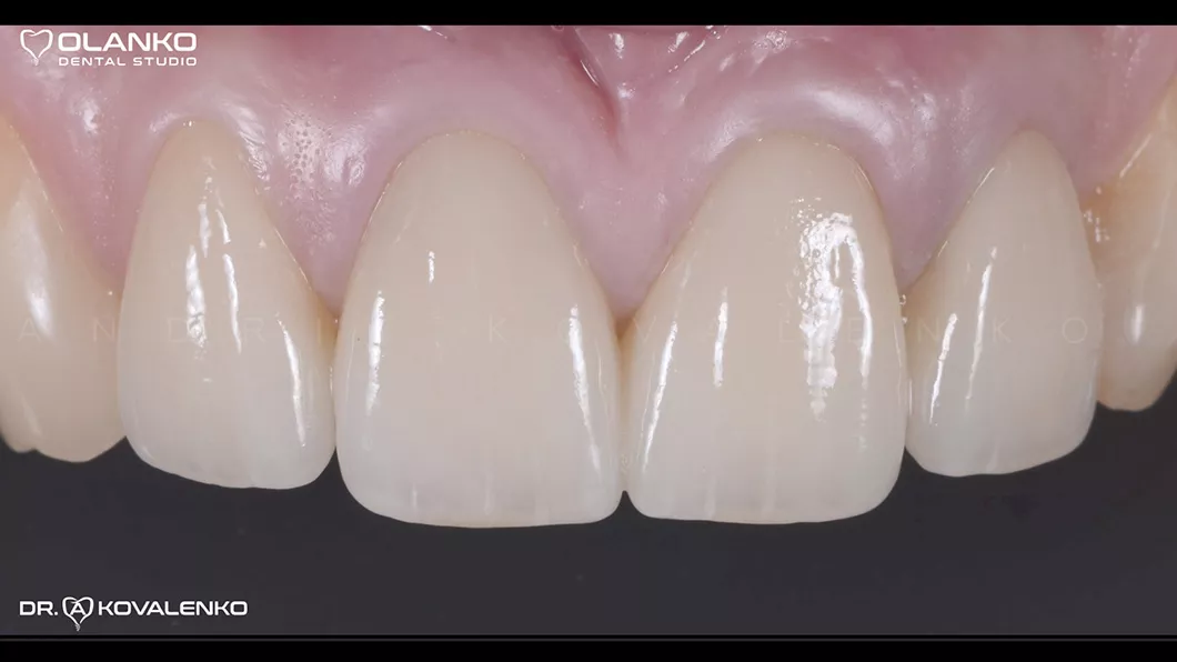 Клинический случай 1 Керамические виниры(коронки)