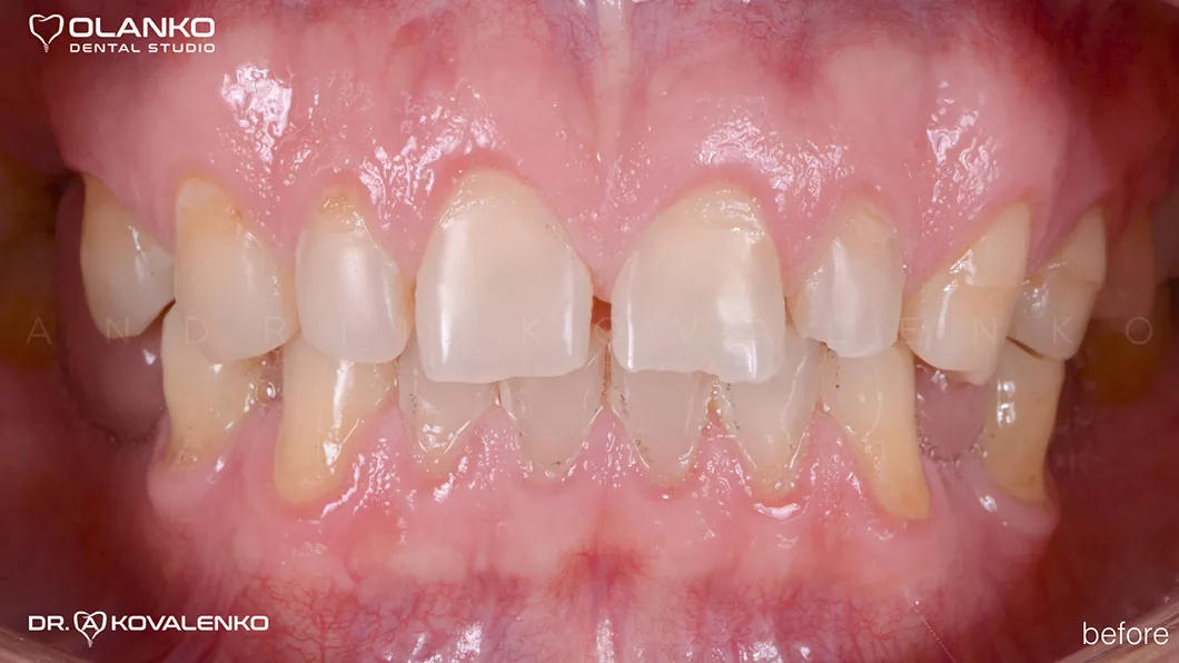 Клинический случай 2 протезирование