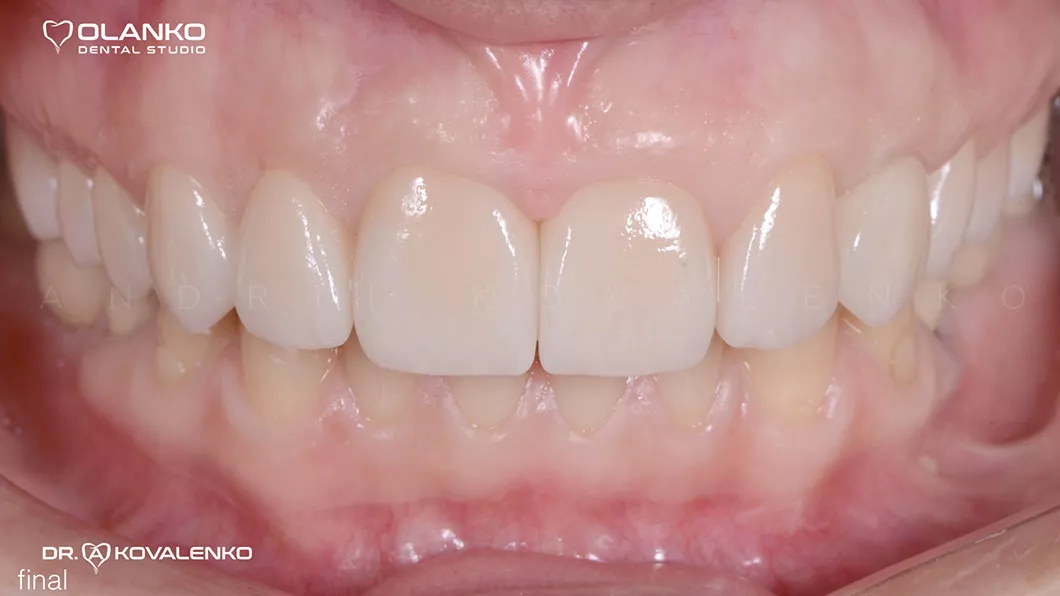 Клинический случай 3 протезирование