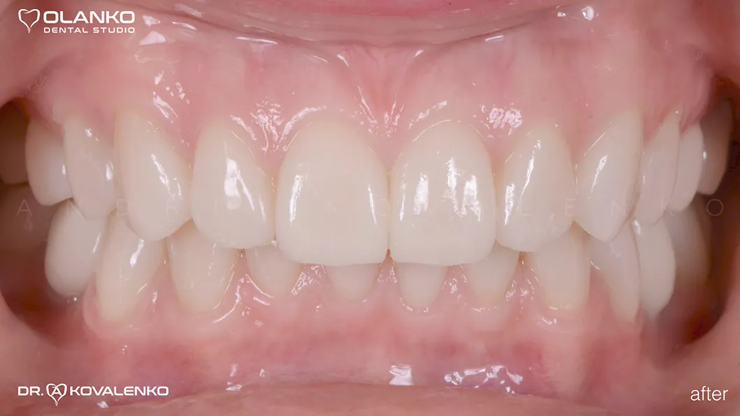 Клинический случай 1 протезирование