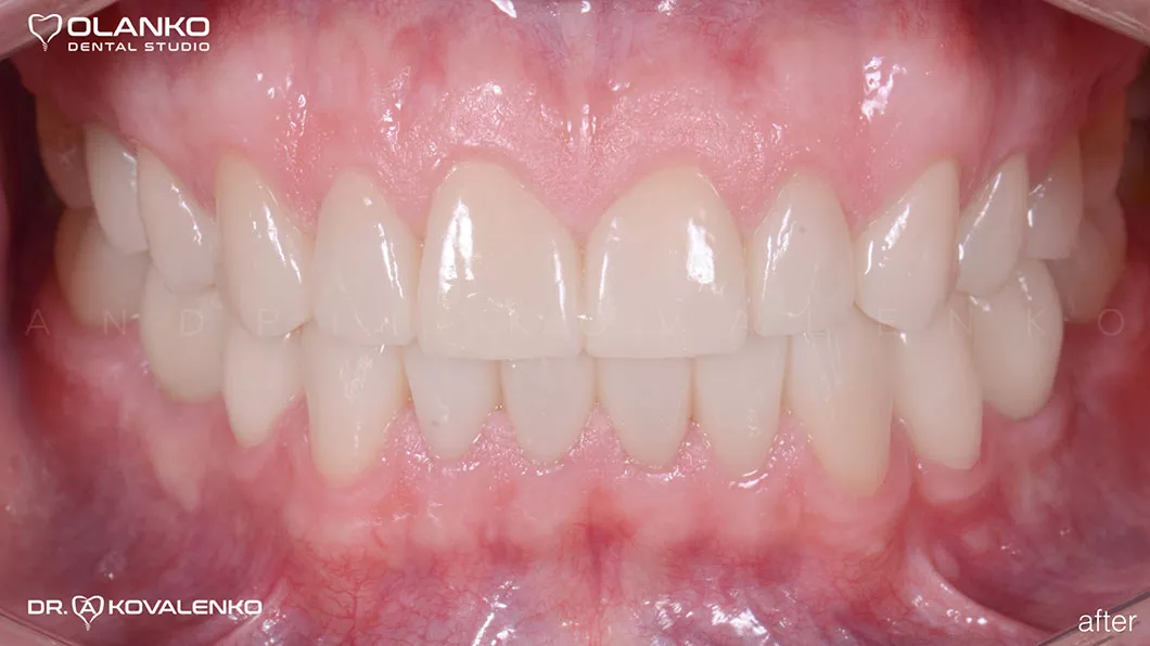 Клинический случай 2 протезирование