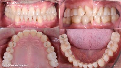 Имплантация зубов,примеры работ до и после.Фотогалерея имплантация зубов.