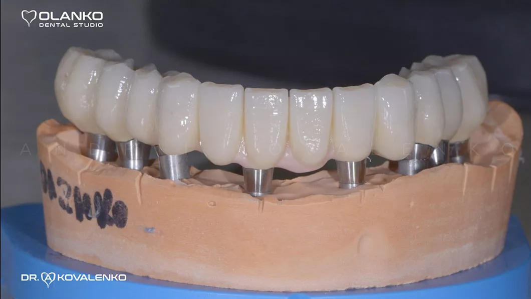 Клинический случай 1 имплантация зубов