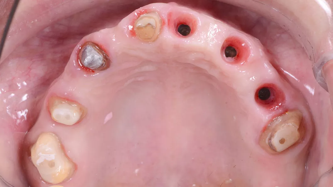 Клинический случай 3 имплантация зубов