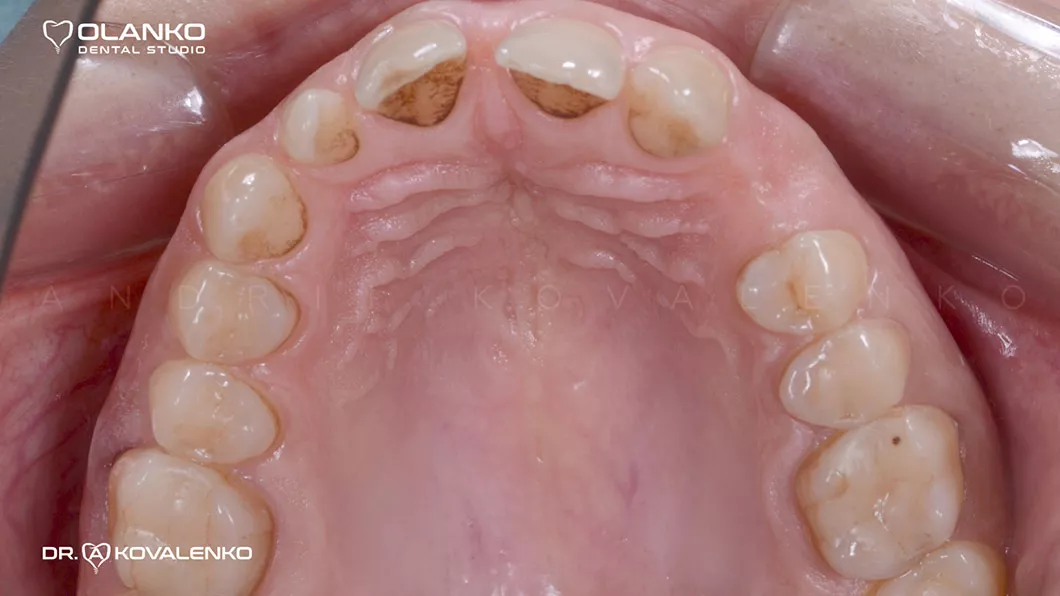 Клинический случай 3 протезирование