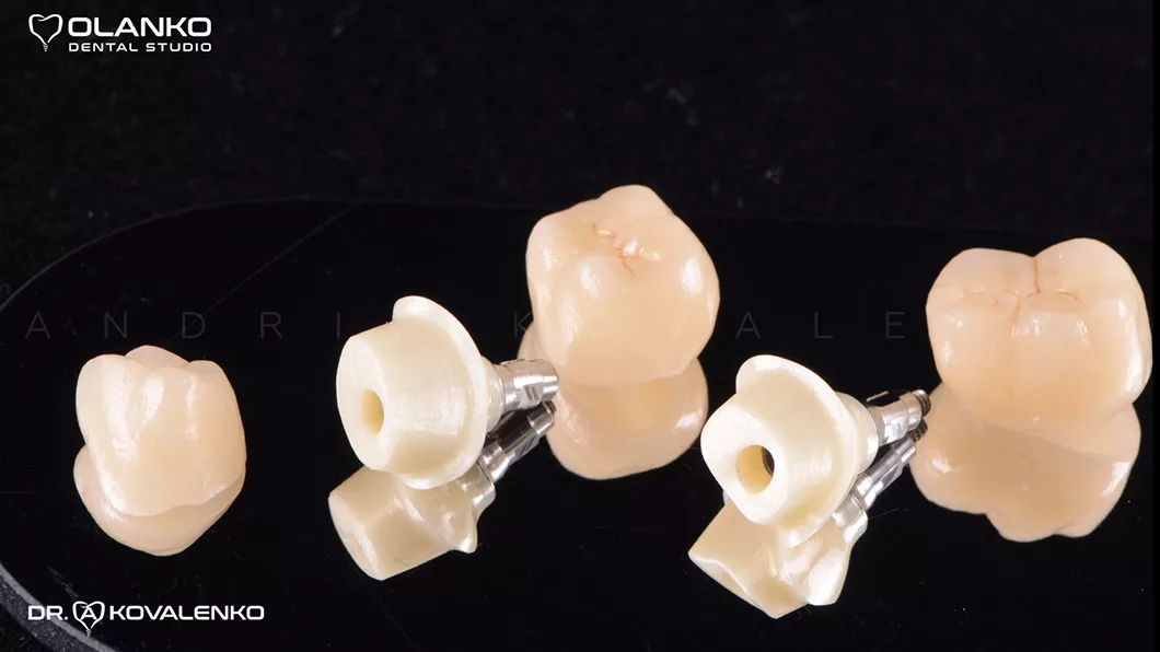 Клинический случай 4 имплантация зубов