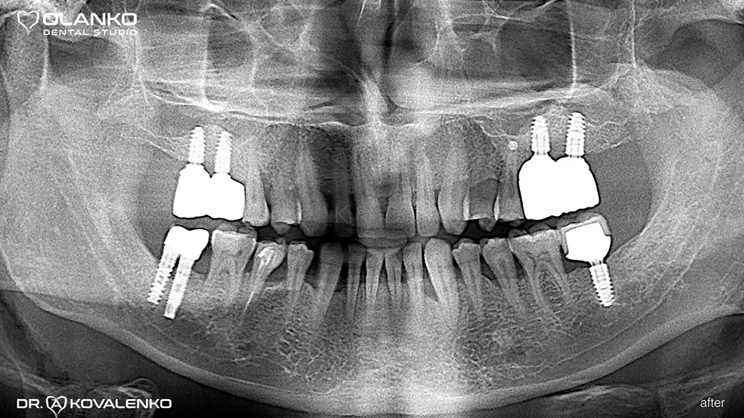 Клинический случай 2 имплантация зубов