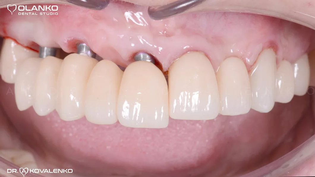Клинический случай 3 имплантация зубов