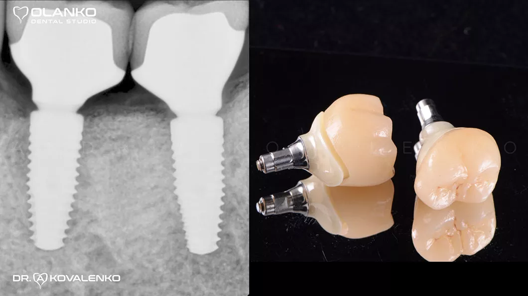 Клинический случай 4 имплантация зубов