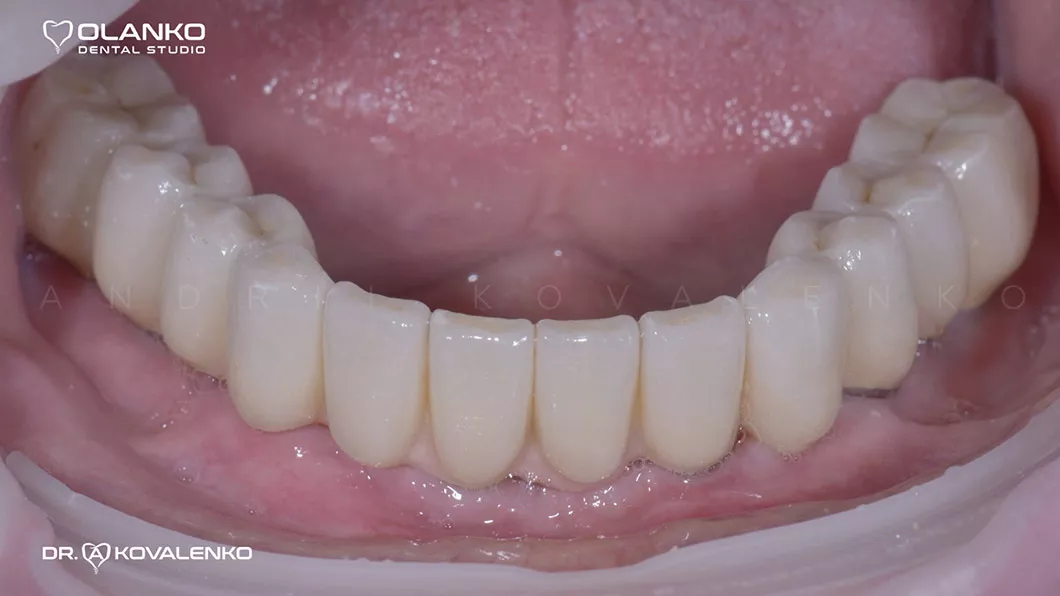 Клинический случай 1 имплантация зубов