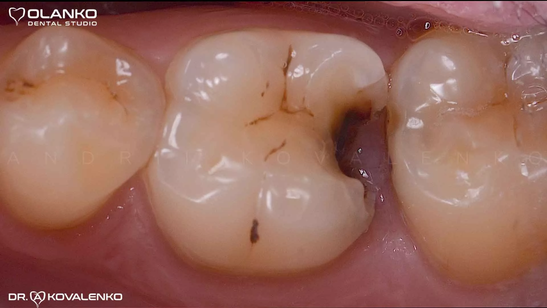 Керамическая вкладка