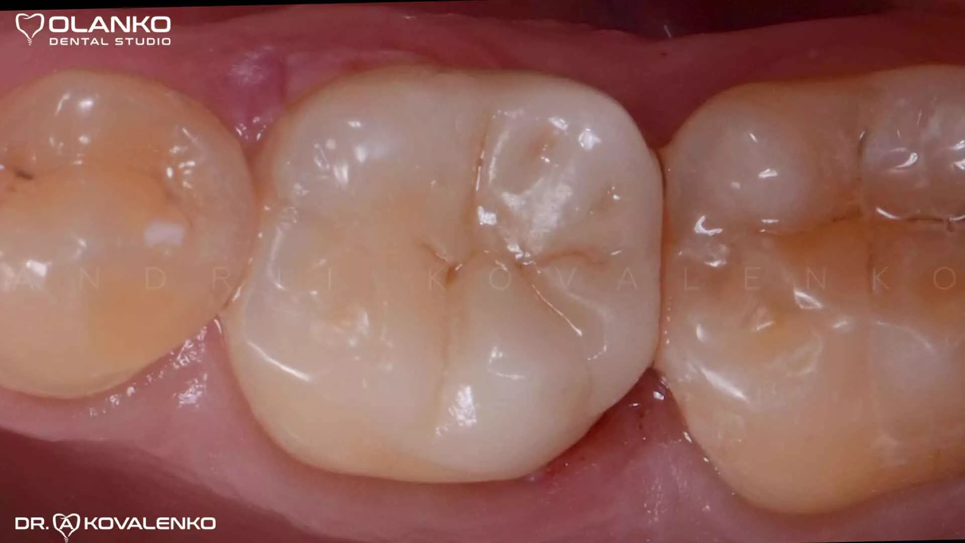 Керамическая вкладка