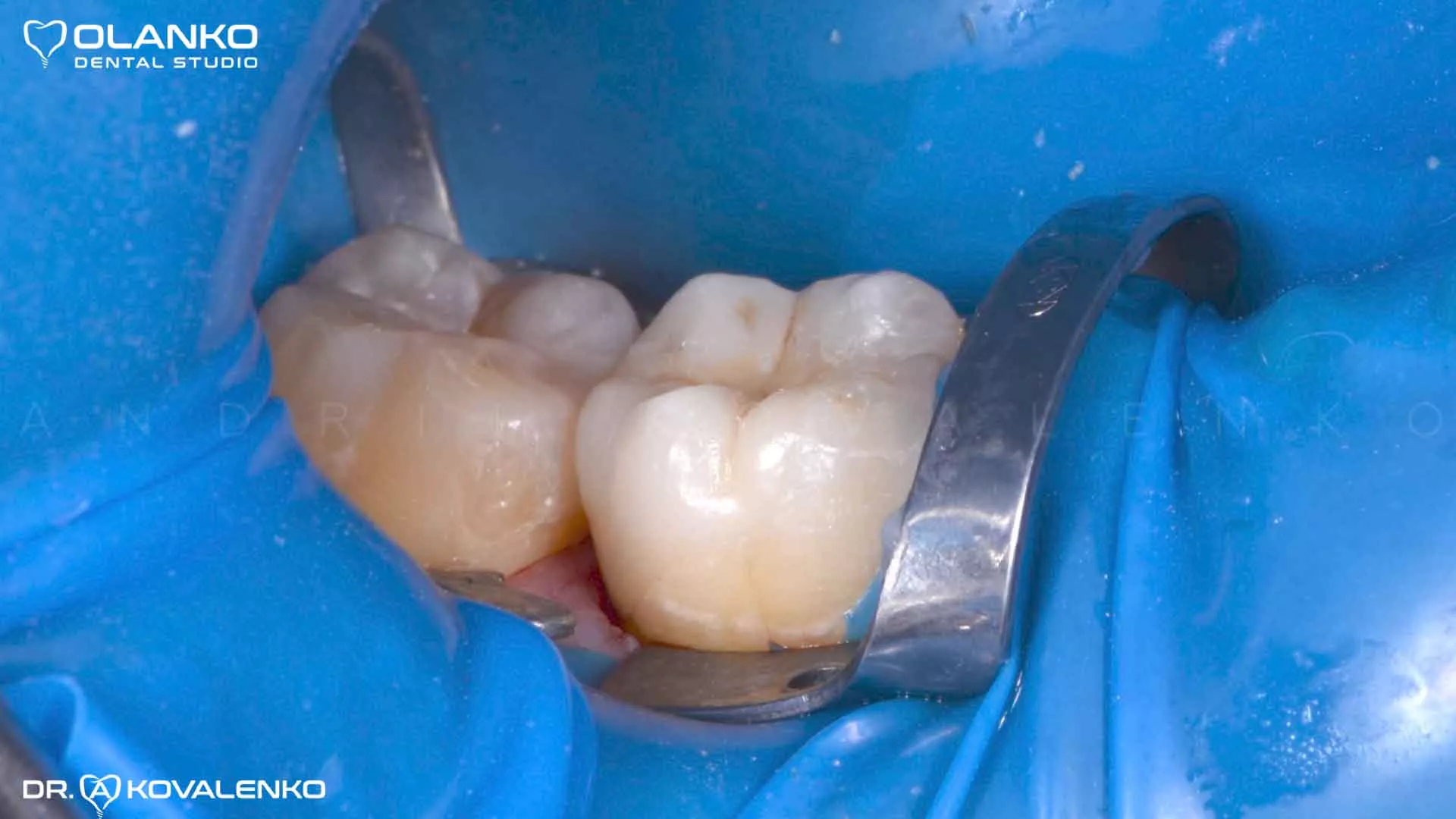 Керамическая вкладка