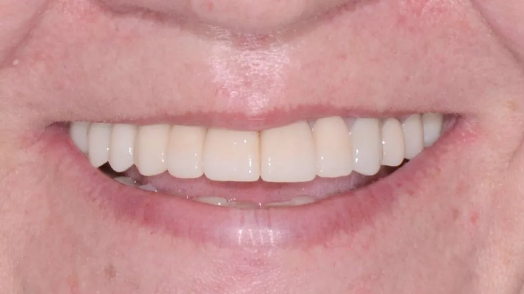 Клинический случай 3 имплантация зубов