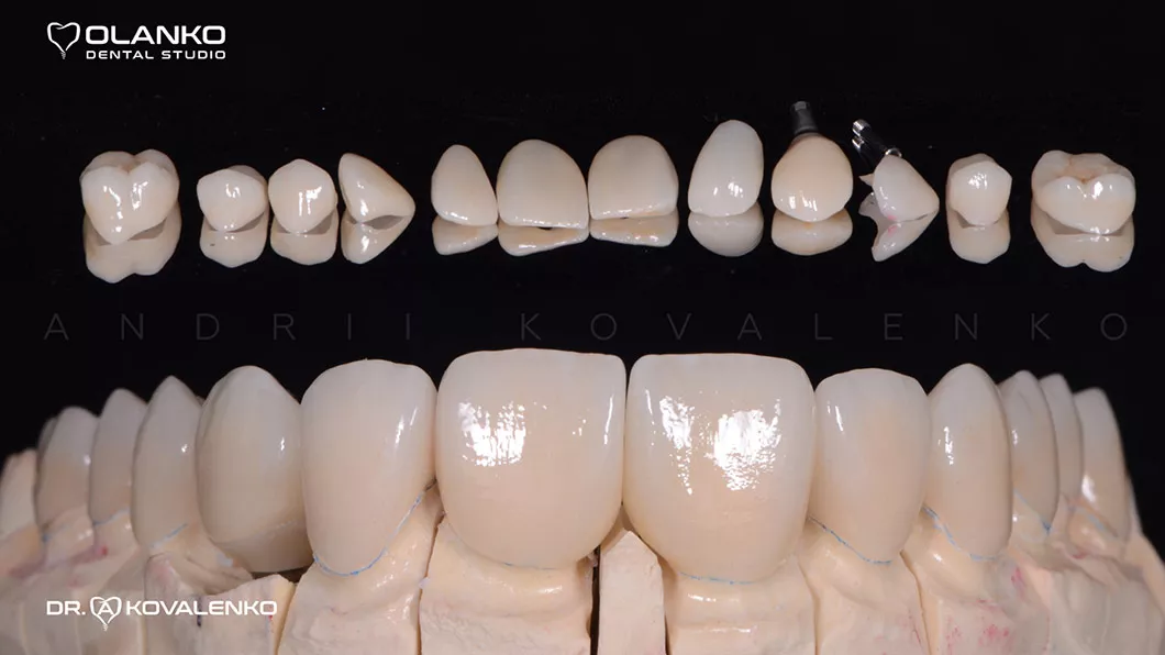 Клинический случай 3 протезирование