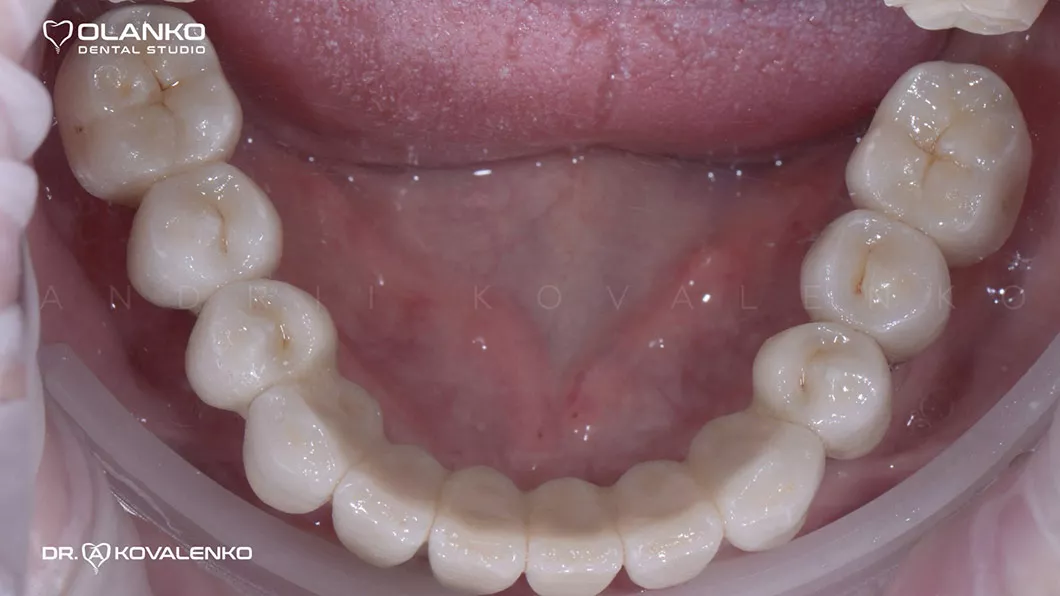 Клинический случай 1 имплантация зубов