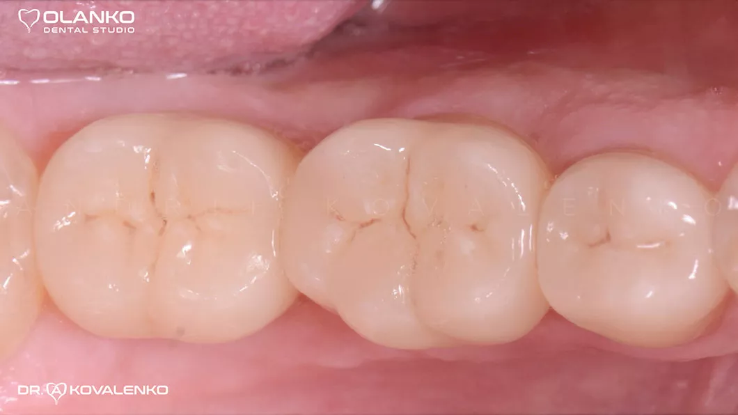 Клинический случай 4 имплантация зубов