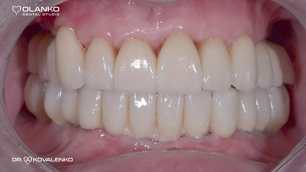 Клинический случай 1 имплантация зубов