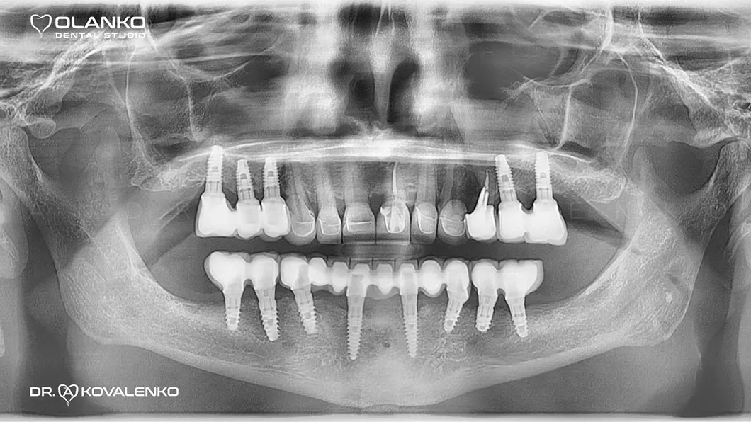 Клинический случай 1 имплантация зубов