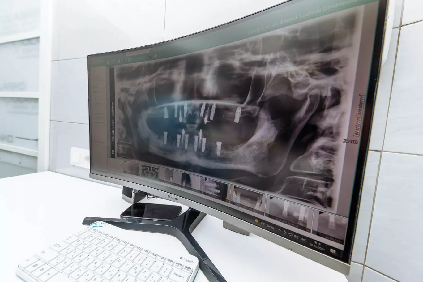 Фото хирургического шаблона для одномоментной установки 5-ти зубных имплантатов Имплантация зубов Бровары