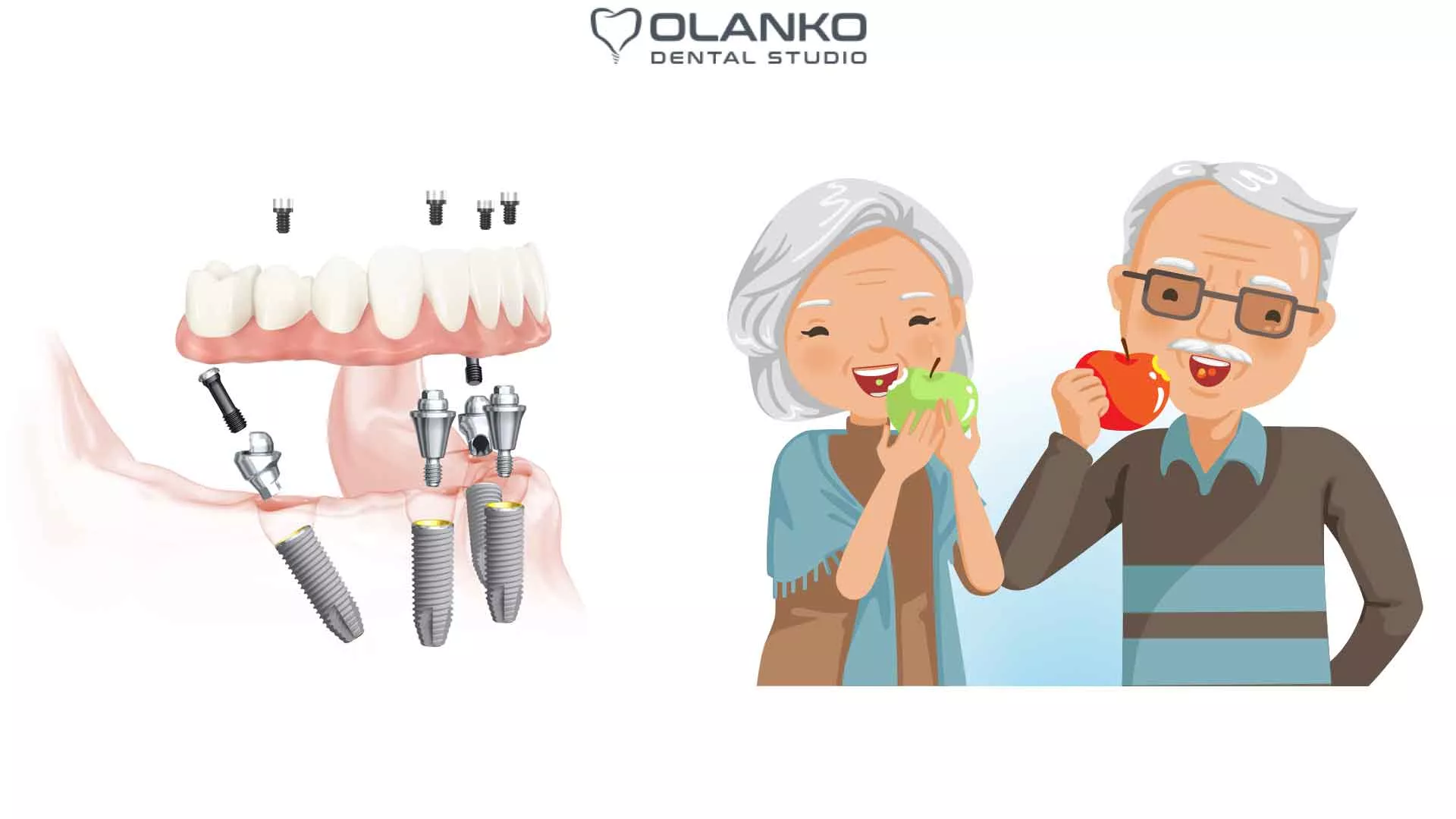 Протезирование зубов all on 4, all on 6