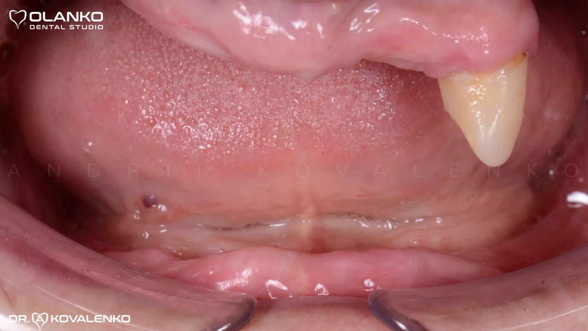 Клинический случай 9 имплантация зубов