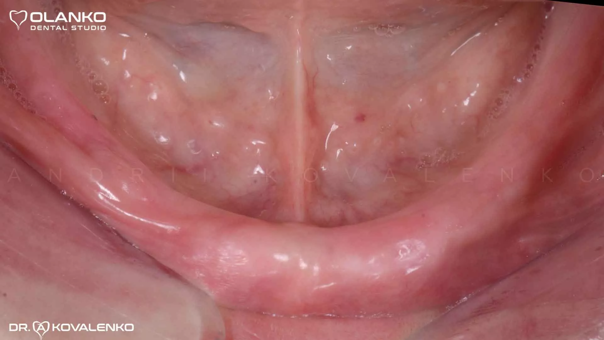 Клинический случай 9 имплантация зубов