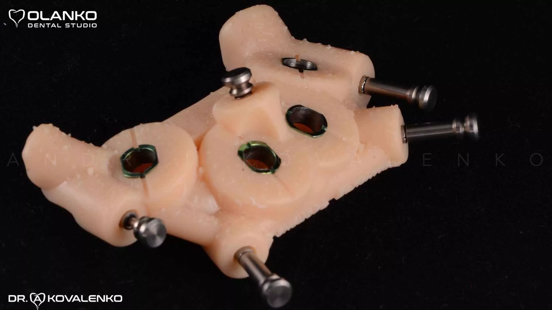 Клинический случай 9 имплантация зубов