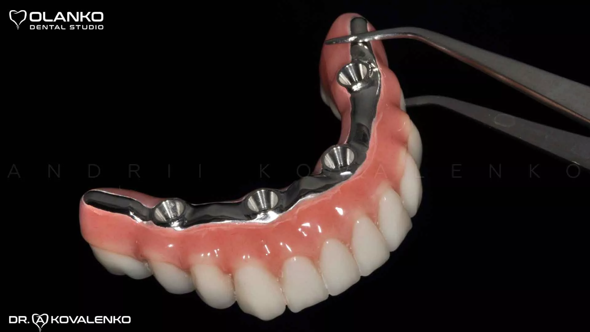 Клинический случай 9 имплантация зубов