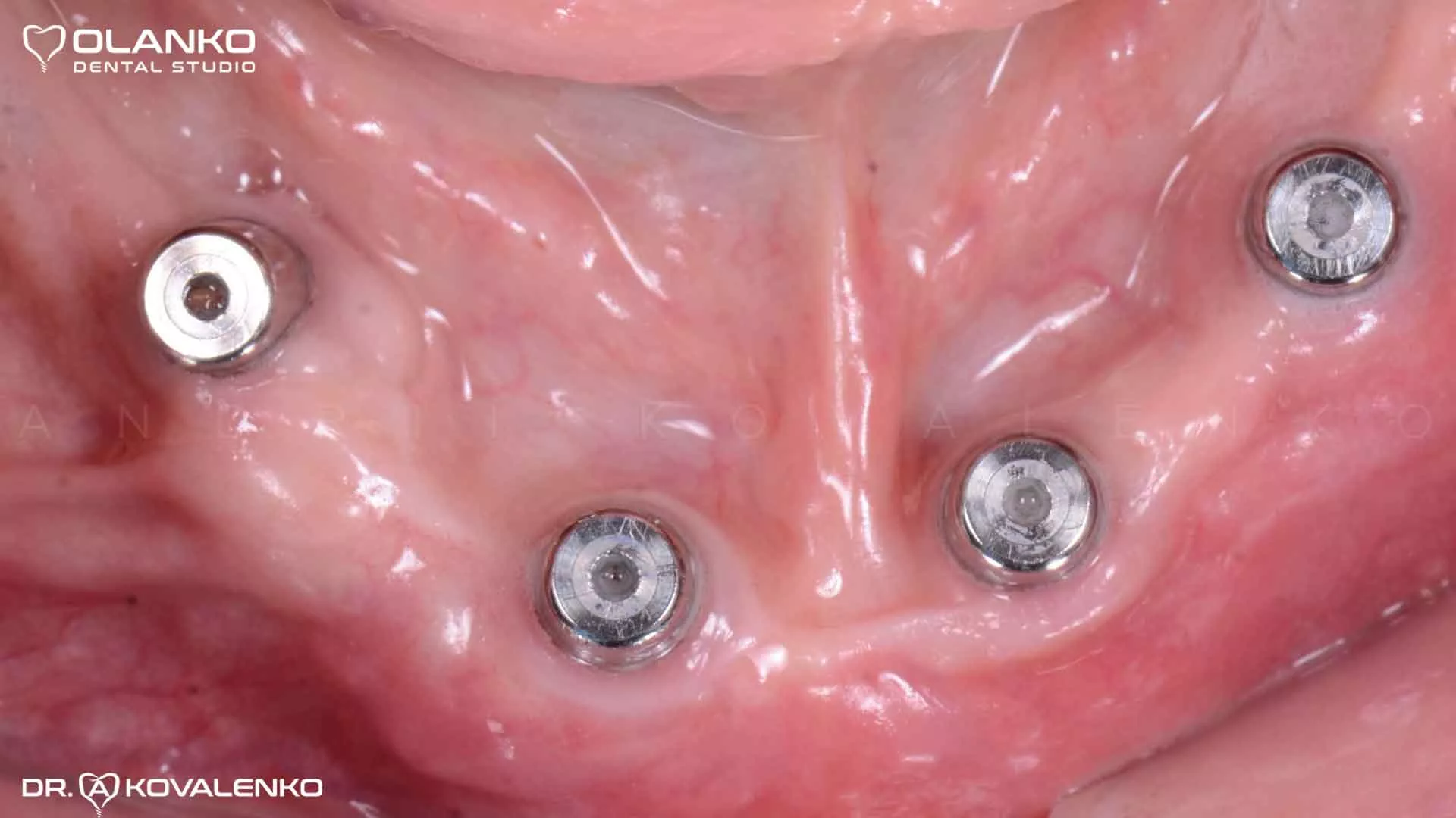 Клинический случай 9 имплантация зубов