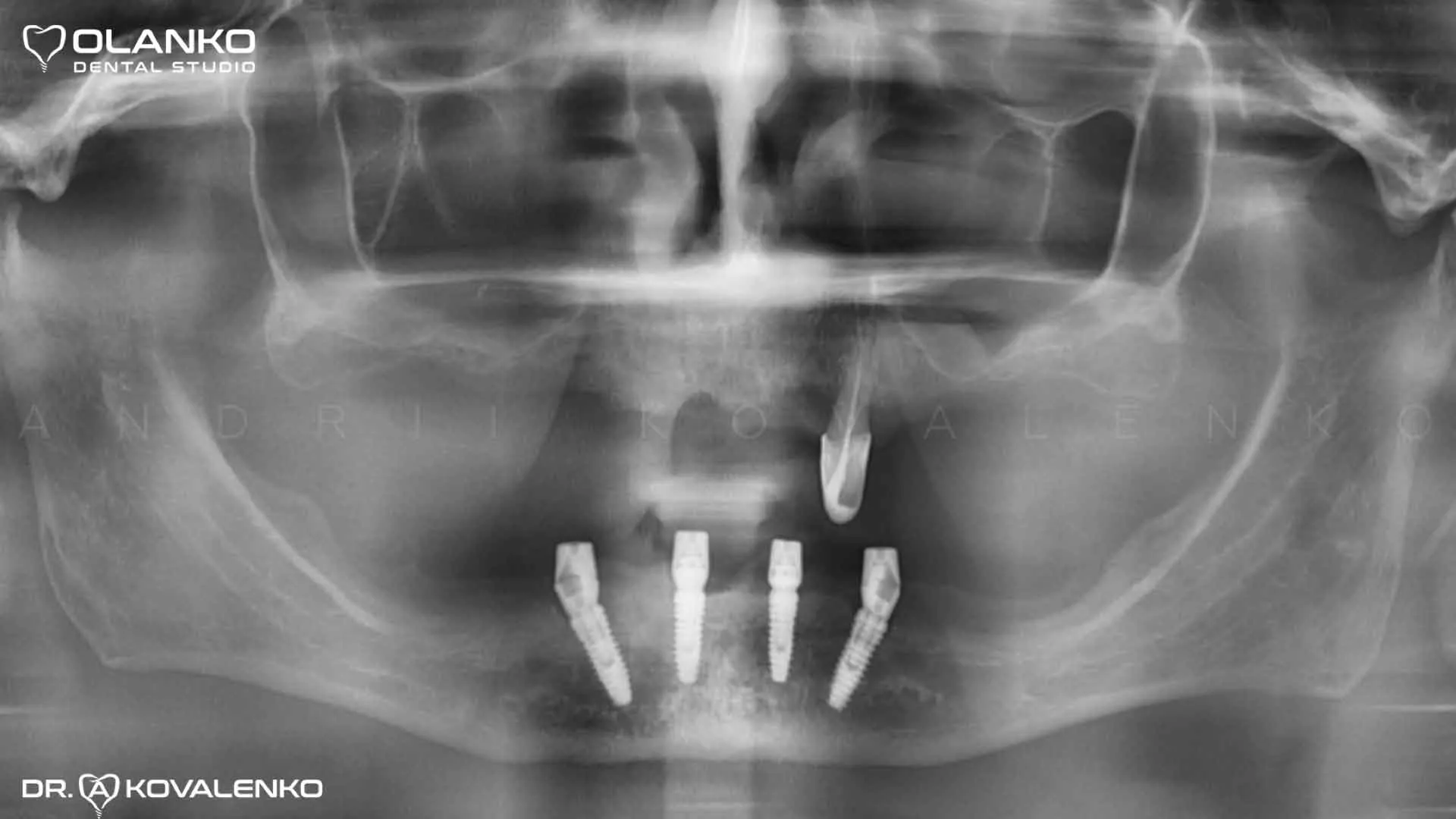 Клинический случай 9 имплантация зубов