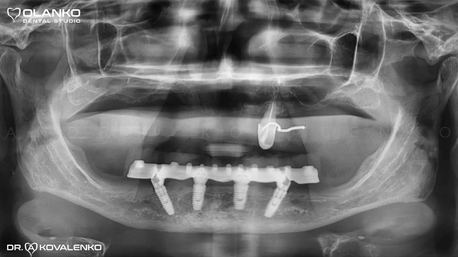 Клинический случай 9 имплантация зубов