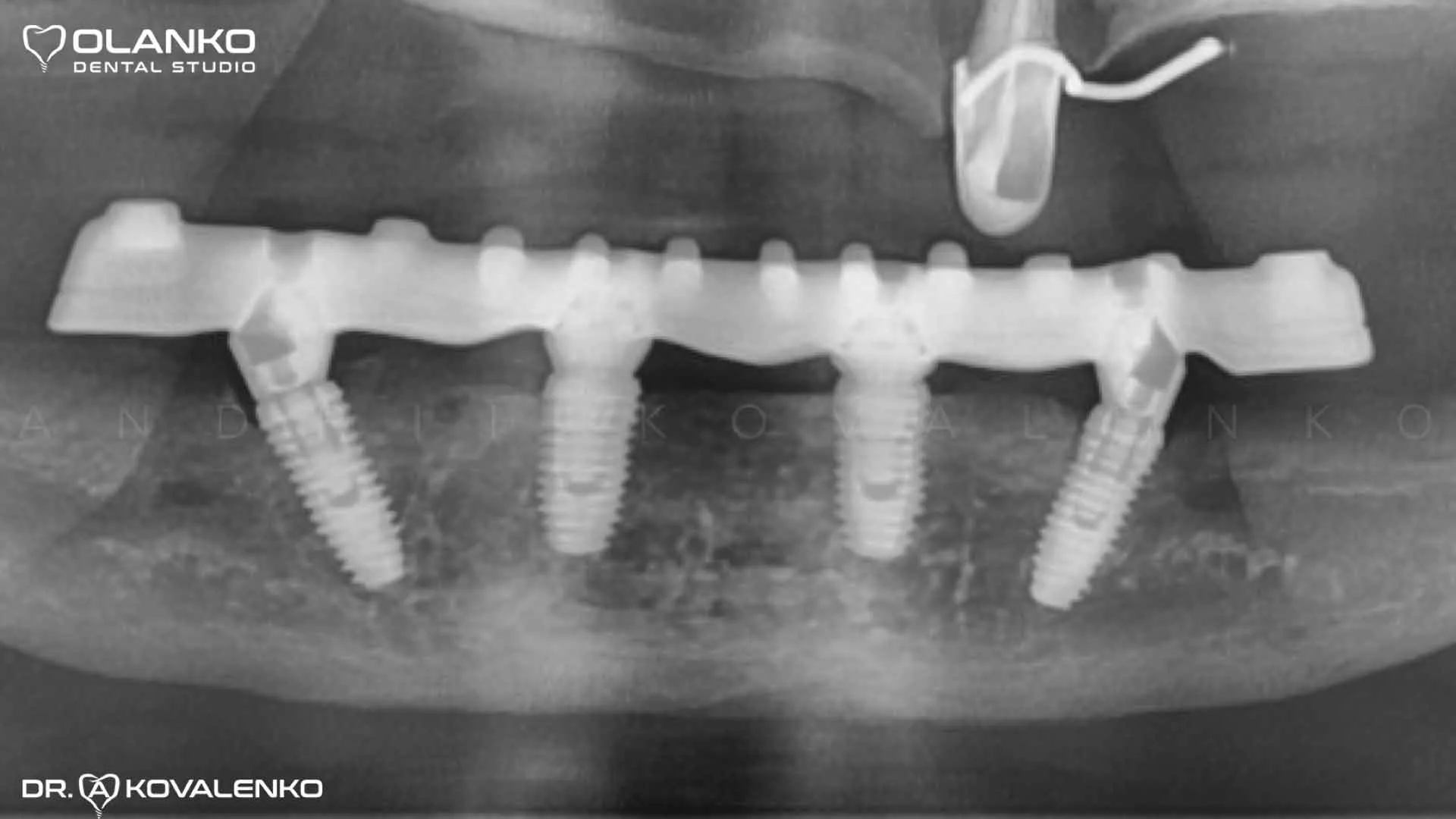 Импланты Nobel система номер 1 в мире