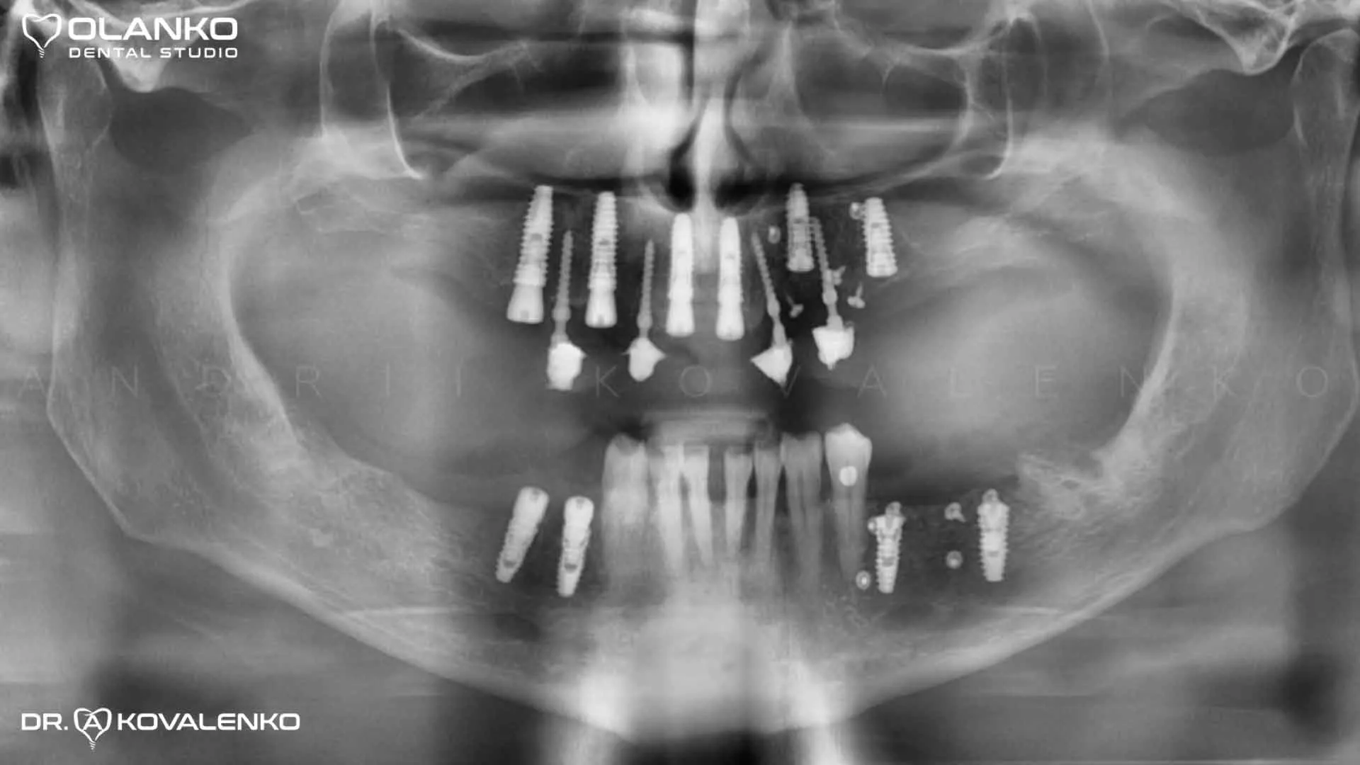Клинический случай 7 имплантация зубов