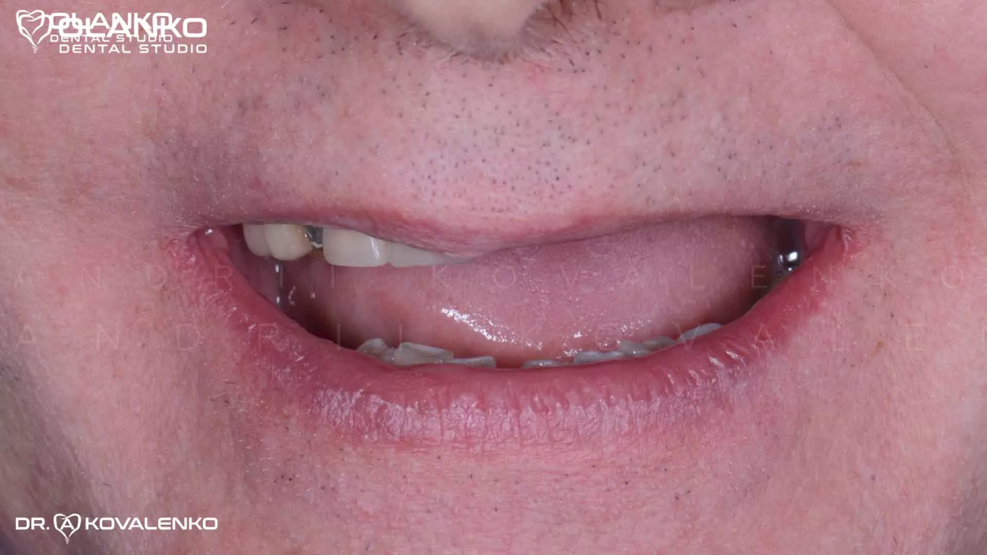 Клинический случай 7 имплантация зубов