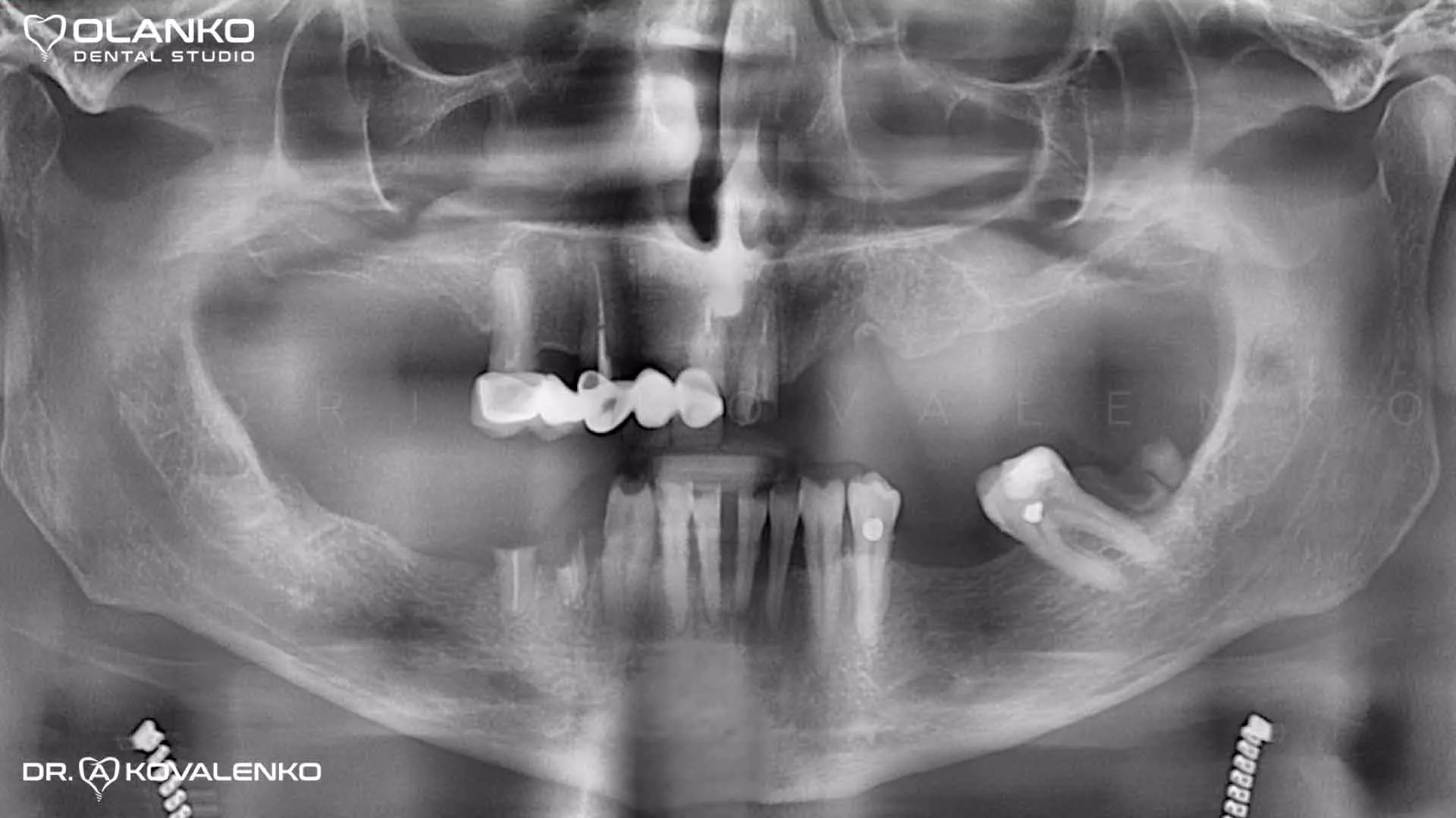 Клинический случай 7 имплантация зубов