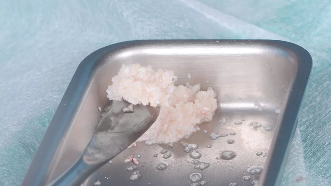 Наращивание костной ткани стоимость Бровары Киев