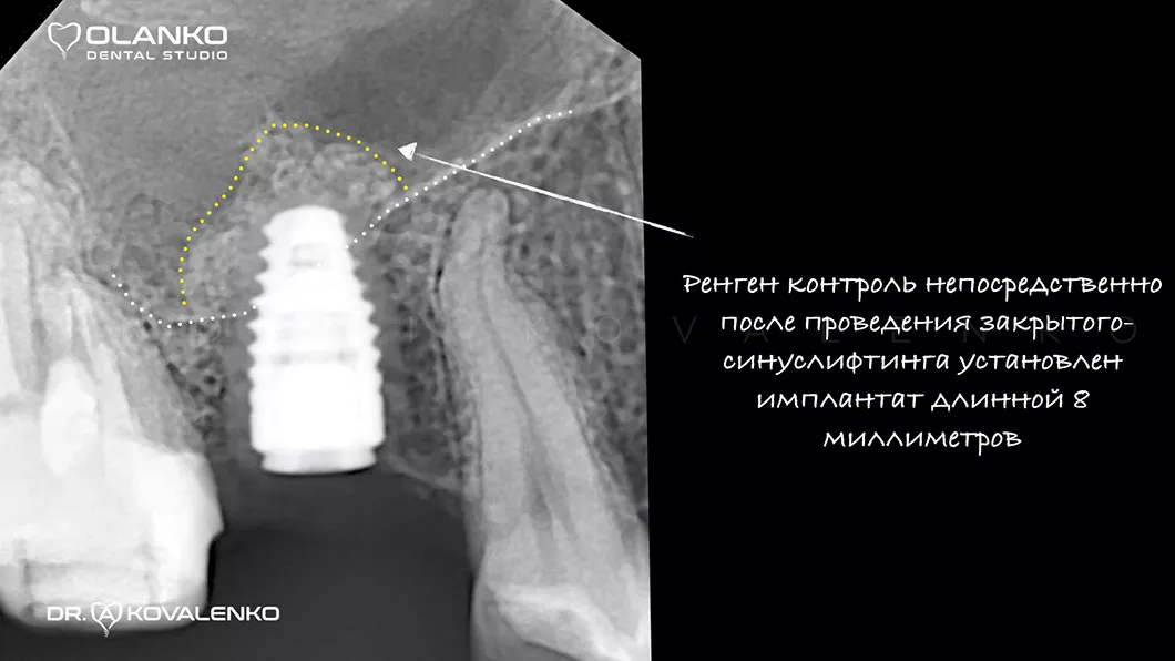 Метод закрытого синус-лифтинга Этап 3